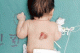A Chinese baby born with a second penis on his back